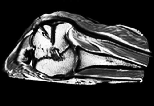 180% thicker tendon vs non-operative control at 12 weeks image